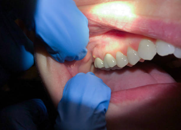 Best Knocked-Out Tooth (Avulsed Tooth) Treatment in Paducah, TX